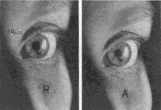 Image of Electric Filament Upon the Cornea